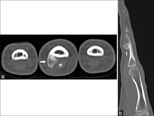Nora Lesion (Bizarre Parosteal Osteochondromatous Proliferation): An Ultrasound Diagnosis with Magnetic Resonance Imaging Correlation.