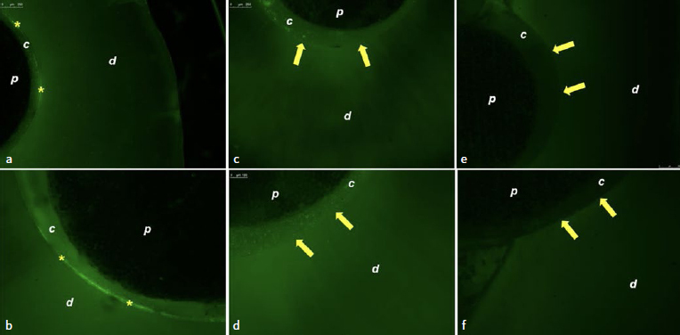 Can Carbodiimide (EDC) and Chitosan Cross-linking Agents Effect the Longevity of Fiberglass Posts Luted with Different Types of Composite Cements to Root Dentin?