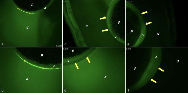 Can Carbodiimide (EDC) and Chitosan Cross-linking Agents Effect the Longevity of Fiberglass Posts Luted with Different Types of Composite Cements to Root Dentin?