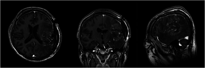 Awake Surgery for a Patient With Glioblastoma and Severe Aphasia: Case Report.