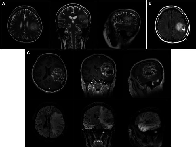 Awake Surgery for a Patient With Glioblastoma and Severe Aphasia: Case Report.