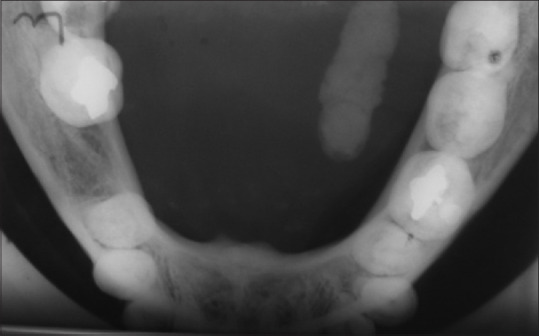 The Diagnostic Challenge of Sialolithiasis.