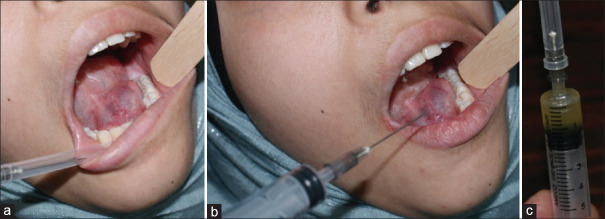 The Diagnostic Challenge of Sialolithiasis.