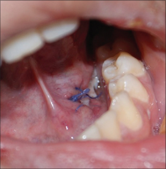 The Diagnostic Challenge of Sialolithiasis.