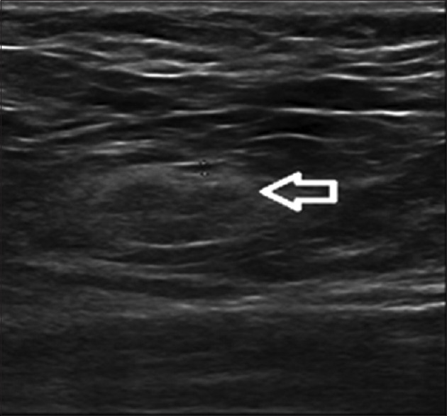 Diagnostic Accuracy of Ultrasonography in Axillary Staging in Breast Cancer Patients.