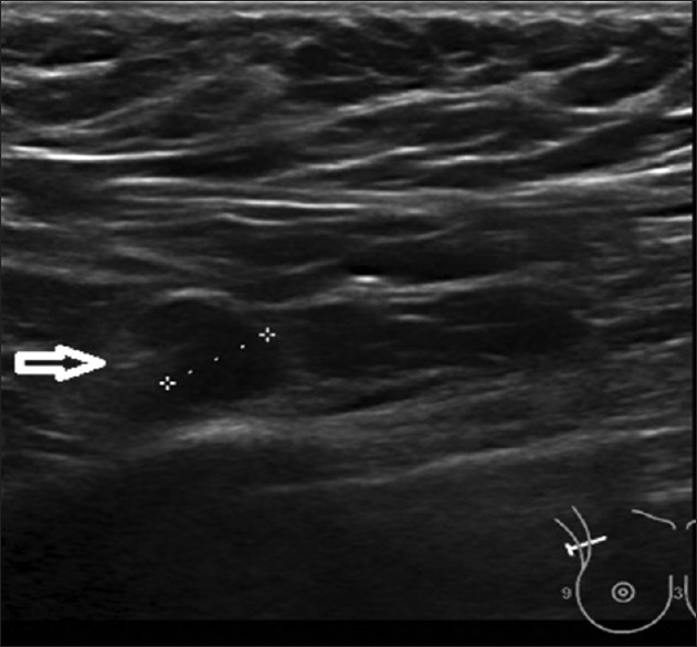 Diagnostic Accuracy of Ultrasonography in Axillary Staging in Breast Cancer Patients.