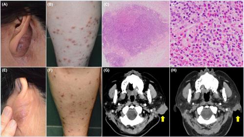 Refractory Kimura's disease accompanied with prurigo responding to dupilumab administration: A case report