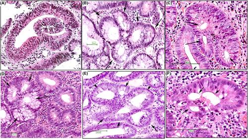 The frequency of dysplastic branching crypts in colorectal polypoid tubular adenomas