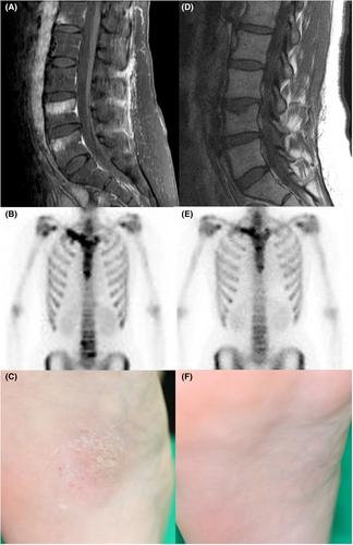 Clinically and radiologically successful treatment of spondylitis by guselkumab in a patient with pustulotic arthro-osteitis