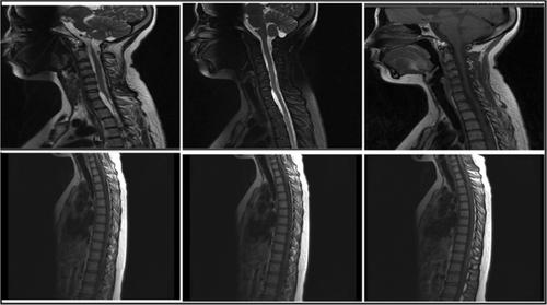 Recurrent bacterial meningitis caused by incomplete Type I inner ear malformation: A case report