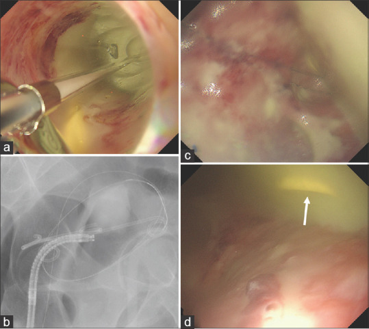 Troubleshooting the migration of a double-pigtail plastic stent into a pelvic abscess (with videos).