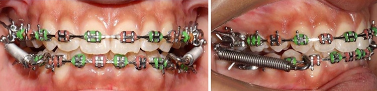 Assessment of Changes in Craniofacial Structures, Bite Force and Periodontal Status Following Fixed Functional Appliance Therapy.