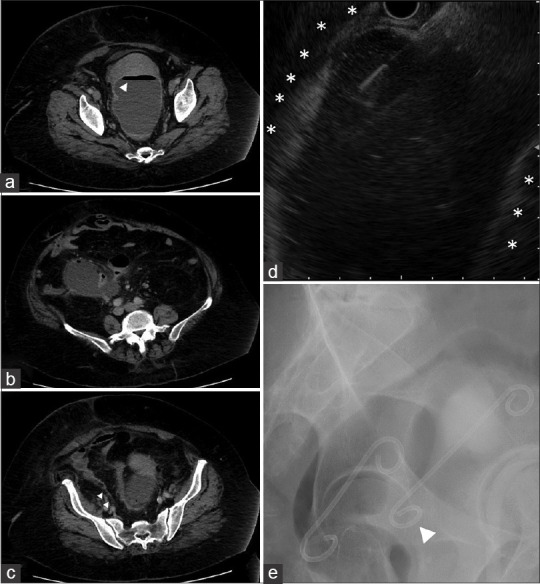 Troubleshooting the migration of a double-pigtail plastic stent into a pelvic abscess (with videos).