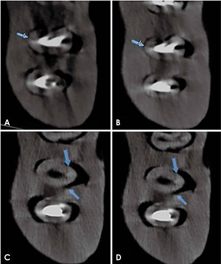 Effect of cone-beam computed tomography metal artefact reduction on incomplete subtle vertical root fractures.