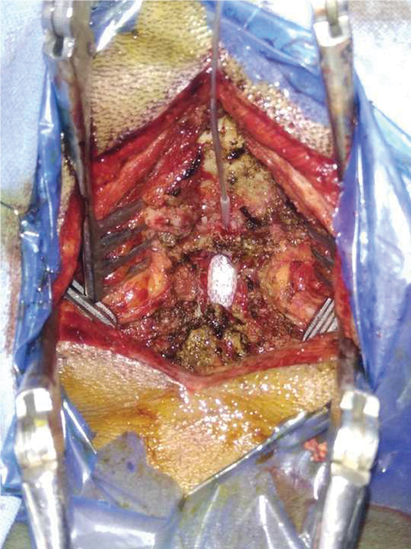 Paddle-Lead Spinal-Cord Stimulation Surgeries for Chronic Neuropathic Pain: A Single Surgeon Case-Series Outcome Analysis in Indian Population.