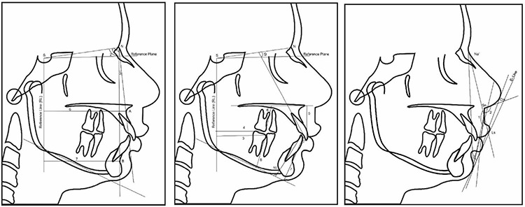 Assessment of Changes in Craniofacial Structures, Bite Force and Periodontal Status Following Fixed Functional Appliance Therapy.