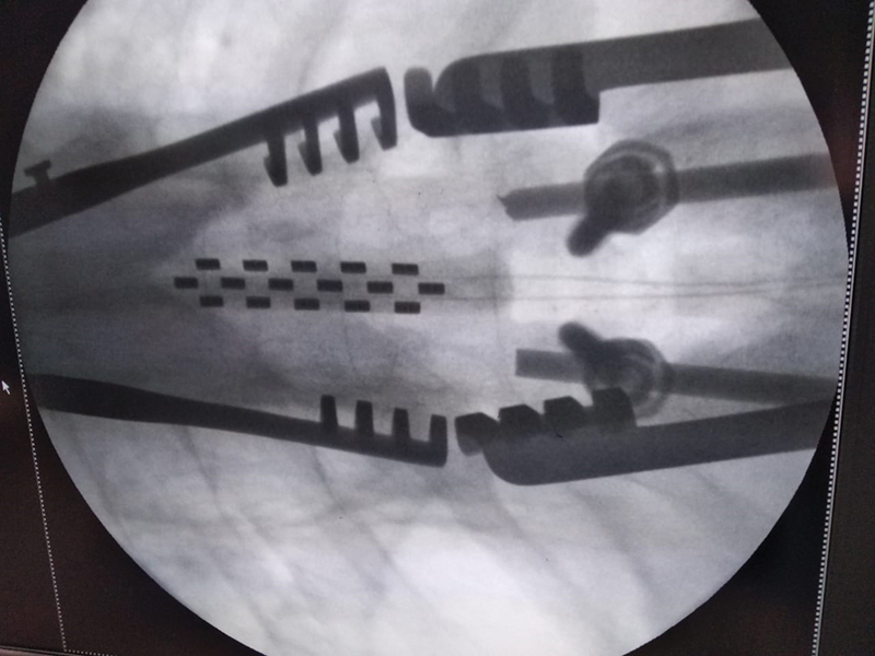 Paddle-Lead Spinal-Cord Stimulation Surgeries for Chronic Neuropathic Pain: A Single Surgeon Case-Series Outcome Analysis in Indian Population.