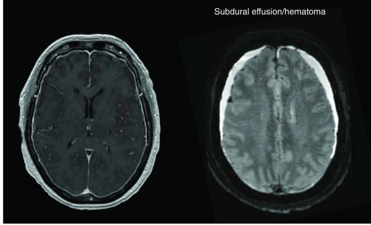 Intracranial hypotension in a breast cancer patient treated with epidural blood patches.