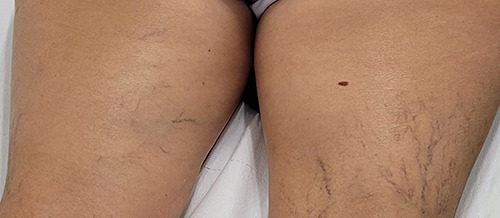 A case of angiomatoid Spitz Nevus in the elderly, with clinical and dermoscopic features.