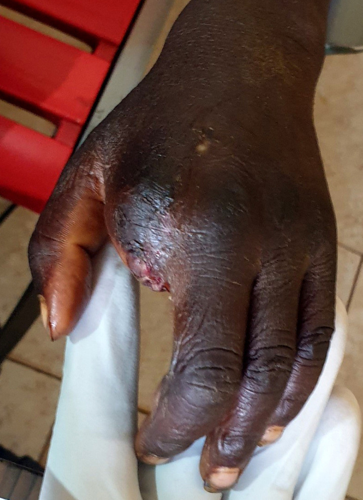 [Local necrosis and infection complicating envenomation with <i>Echis ocellatus</i> in a child in Mali].