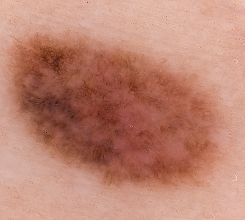 A case of angiomatoid Spitz Nevus in the elderly, with clinical and dermoscopic features.