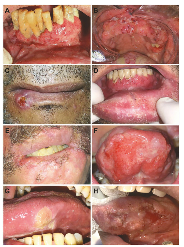 Oral paracoccidioidomycosis: a retrospective study of 95 cases from a single center and literature review.