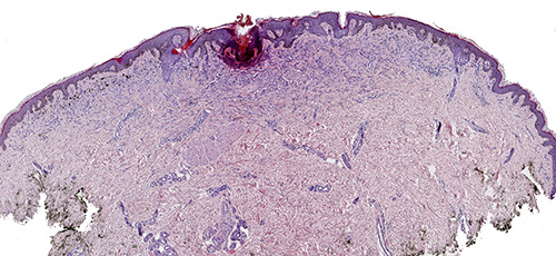 A case of angiomatoid Spitz Nevus in the elderly, with clinical and dermoscopic features.