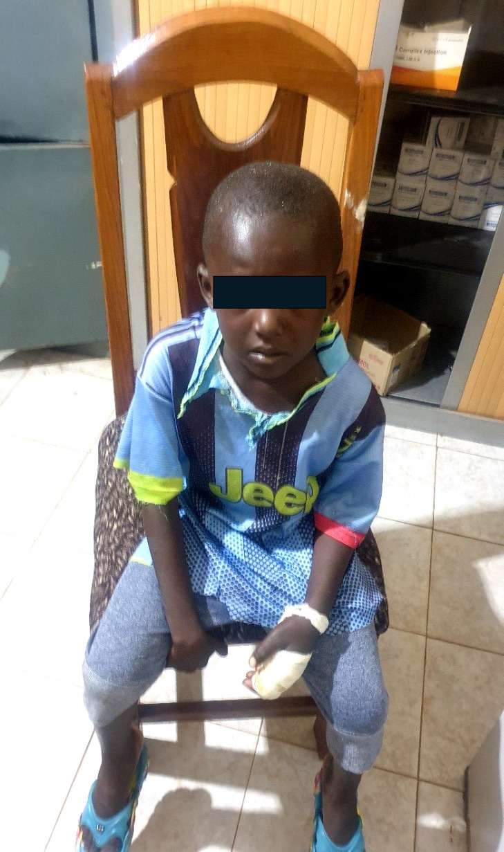 [Local necrosis and infection complicating envenomation with <i>Echis ocellatus</i> in a child in Mali].