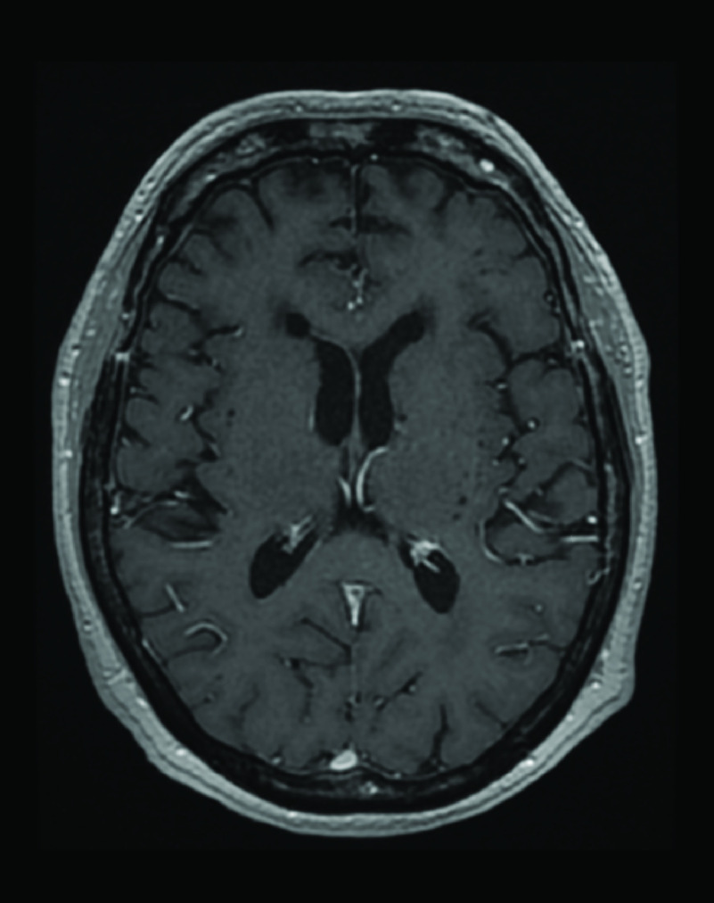 Intracranial hypotension in a breast cancer patient treated with epidural blood patches.