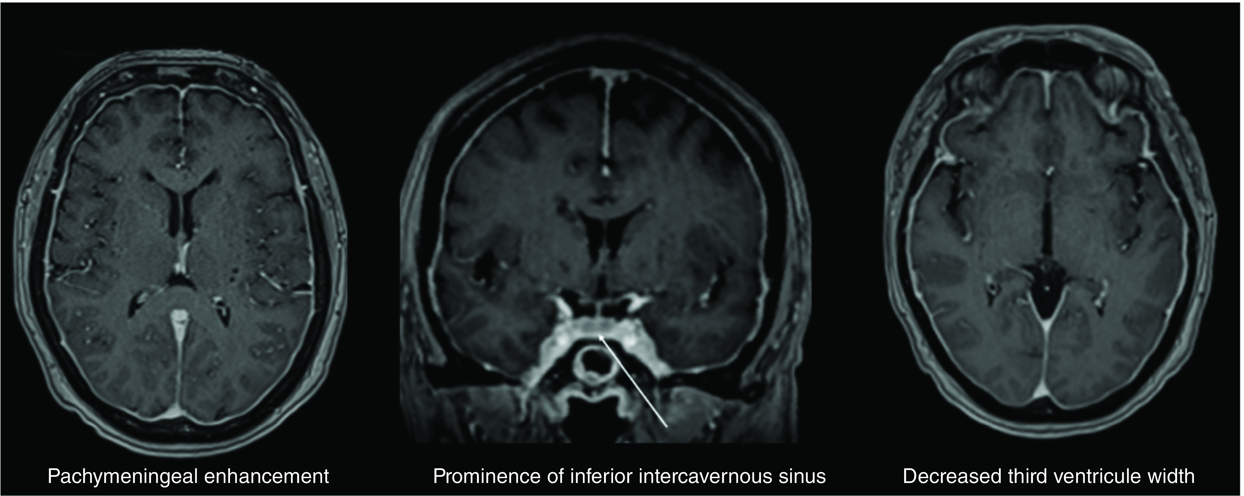 Intracranial hypotension in a breast cancer patient treated with epidural blood patches.