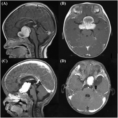 Spontaneous regression of tumor in a girl with optic pathway glioma with diencephalic syndrome.