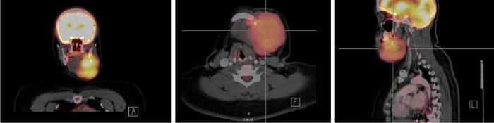 Challenges in the care of Ewing’s sarcoma in a Jehovah’s Witness patient