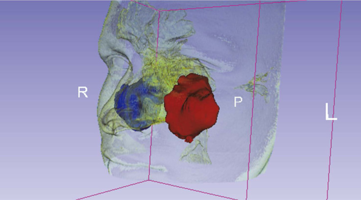 Maxillary sinus volumetric changes in jet aircraft pilots: A multislice computed tomography pilot study.