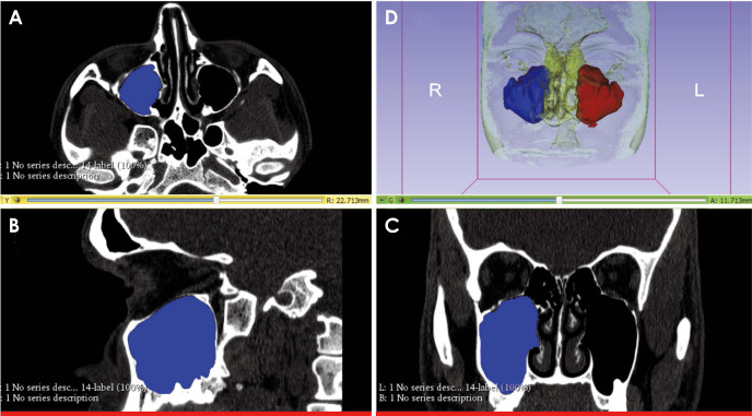 Maxillary sinus volumetric changes in jet aircraft pilots: A multislice computed tomography pilot study.