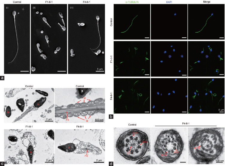 Patients with MMAF induced by novel biallelic CFAP43 mutations have good fertility outcomes after intracytoplasmic sperm injection.