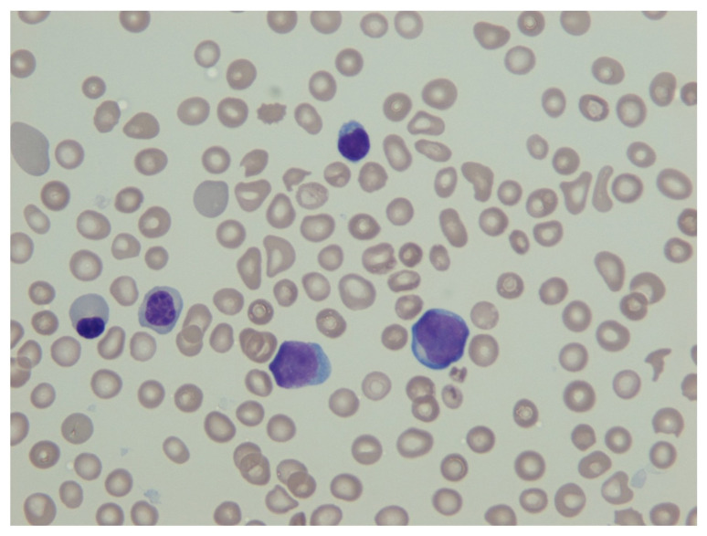 t(1;7;22)(p13;q21;q13) is a novel 3-way variant of t(1;22)(p13;q13) neonatal acute megakaryoblastic leukemia: A case report.