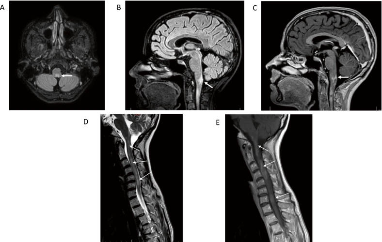 Paroxysmal painful tonic spasms in neuromyelitis optica spectrum disorder