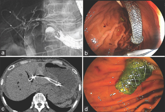 A pilot study of Spring Stopper Stents: Novel partially covered self-expandable metallic stents with anti-migration properties for EUS-guided hepaticogastrostomy.