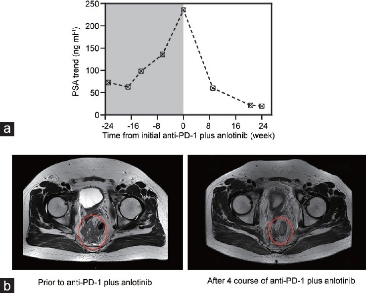 PD-1 inhibitor plus anlotinib for metastatic castration-resistant prostate cancer: a real-world study.