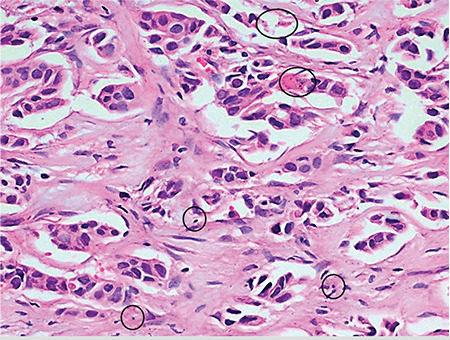 Does Apoptotic Index Predict the Response to Neoadjuvant Chemotherapy in Patients with Breast Carcinoma?