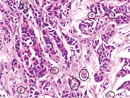 Does Apoptotic Index Predict the Response to Neoadjuvant Chemotherapy in Patients with Breast Carcinoma?