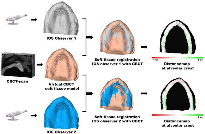 Intraoral scanning of the edentulous jaw without additional markers: An <i>in vivo</i> validation study on scanning precision and registration of an intraoral scan with a cone-beam computed tomography scan.