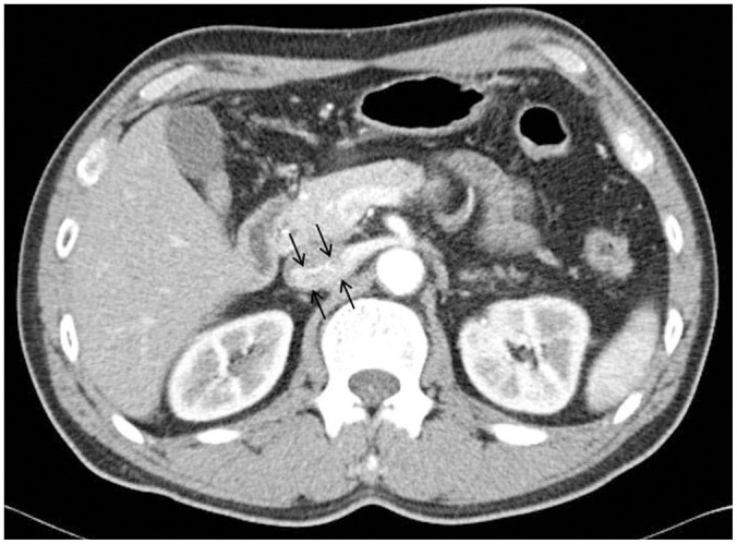 CT Evaluation of the Findings of Nutcracker Syndrome in Patients with Bladder Cancer after Radical Cystectomy and Ileal Neobladder Formation: A Correlation with Hematuria.