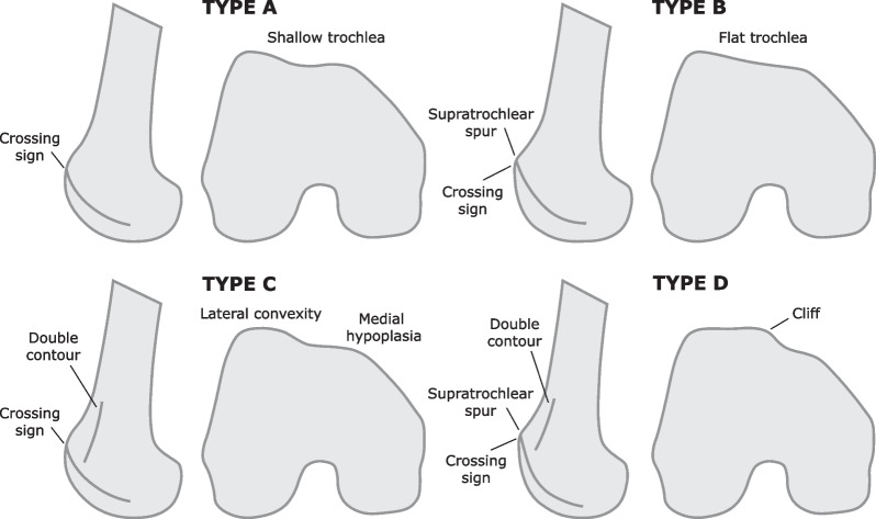 Imaging evaluation of patellofemoral joint instability: a review.