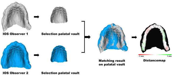 Intraoral scanning of the edentulous jaw without additional markers: An <i>in vivo</i> validation study on scanning precision and registration of an intraoral scan with a cone-beam computed tomography scan.