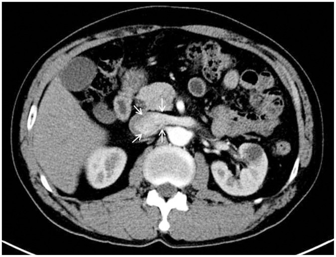 CT Evaluation of the Findings of Nutcracker Syndrome in Patients with Bladder Cancer after Radical Cystectomy and Ileal Neobladder Formation: A Correlation with Hematuria.