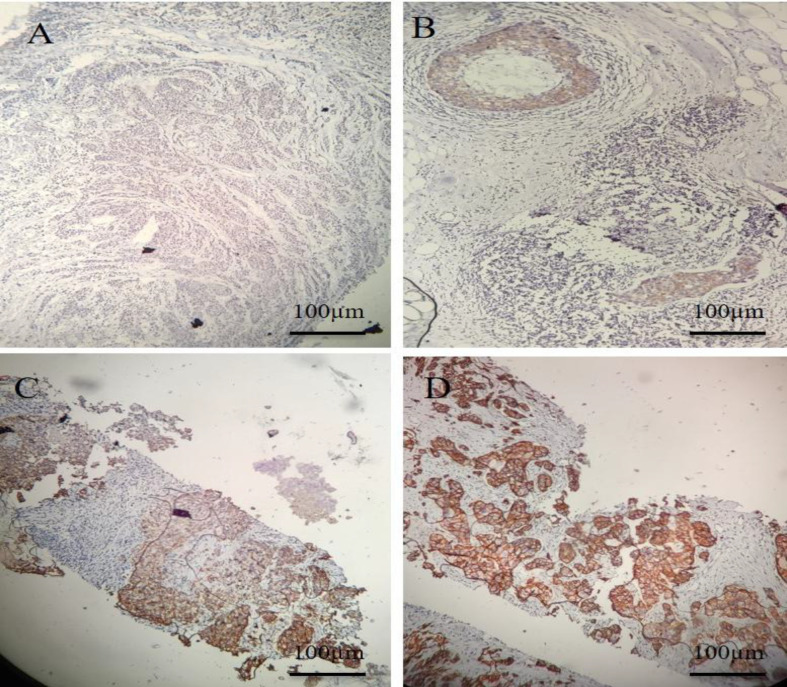 K-Ras4A Plays a More Significant Role than K-Ras4B in Ductal Carcinoma of Breast.