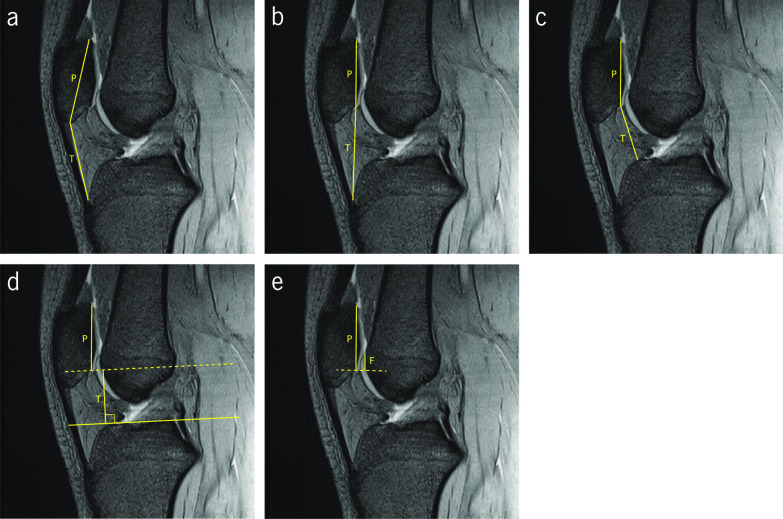 Imaging evaluation of patellofemoral joint instability: a review.