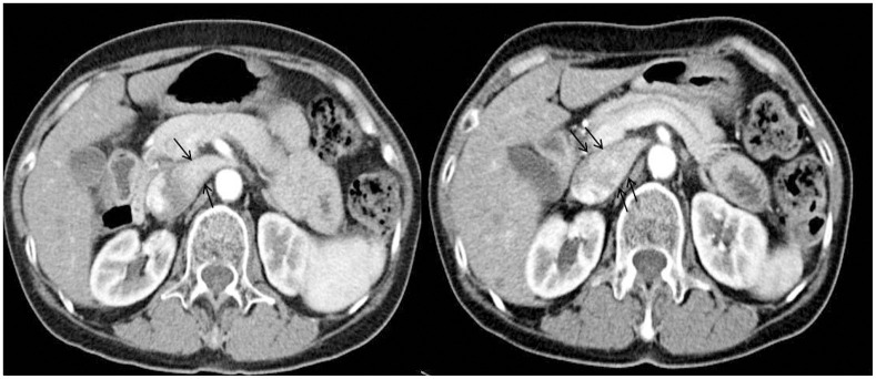 CT Evaluation of the Findings of Nutcracker Syndrome in Patients with Bladder Cancer after Radical Cystectomy and Ileal Neobladder Formation: A Correlation with Hematuria.