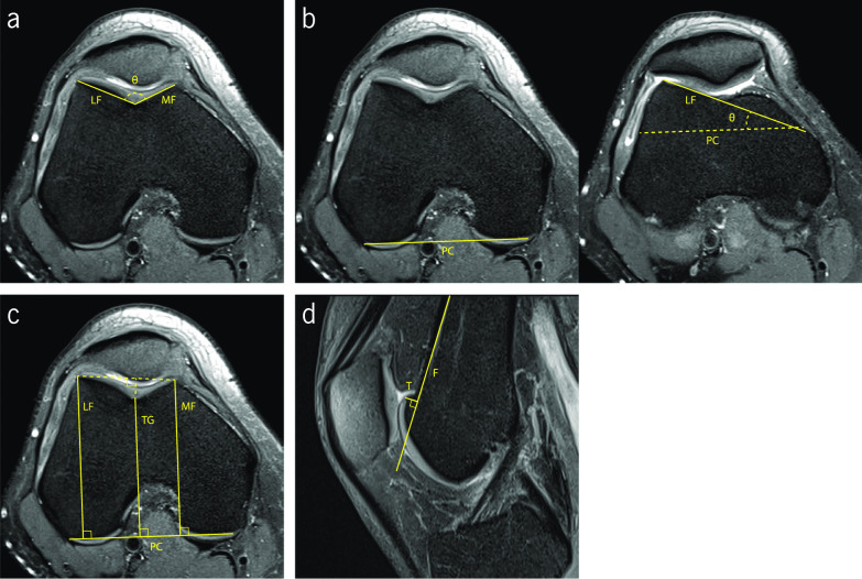 Imaging evaluation of patellofemoral joint instability: a review.